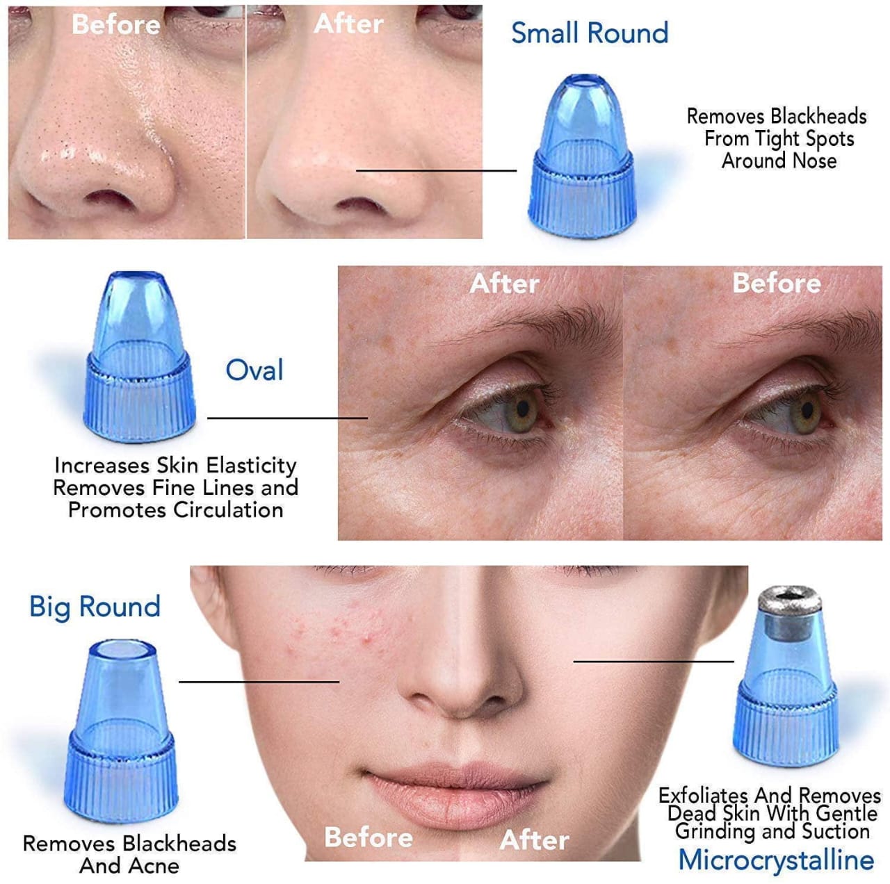 Derma Suction Blackhead Remover Vacuum Suck The Yuck Out Of Your Pores (cell Operated) - the makoza hub